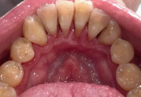 Có nên đi lấy cao răng? Thời gian, chi phí và những lưu ý 